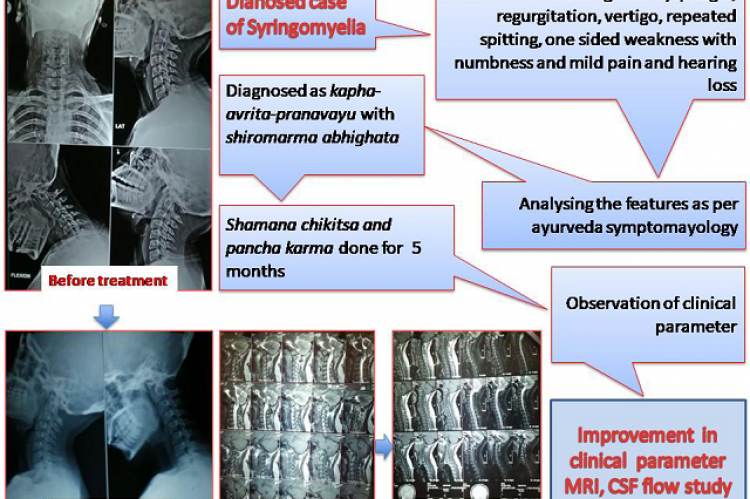 Ayurveda Management of Syringomyelia - A single Case Study
